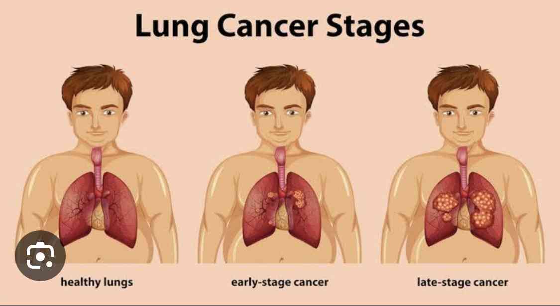 Types of lung cancer - MirrorLog