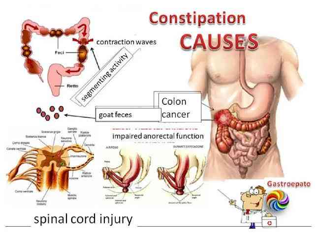 Causes Of Constipation MirrorLog causes-of-constipation-mirrorlog