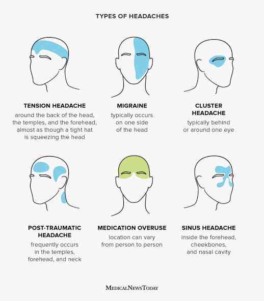 Types Of Headaches MirrorLog types-of-headaches-mirrorlog