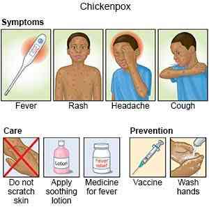 Symptoms of chickenpox - MirrorLog.com