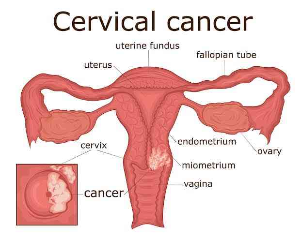 Cervical cancer - MirrorLog