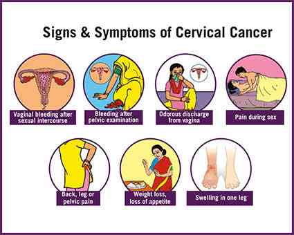 Symptoms of cervical cancer - MirrorLog